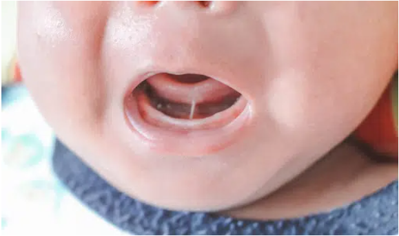 Tongue Tie Surgery